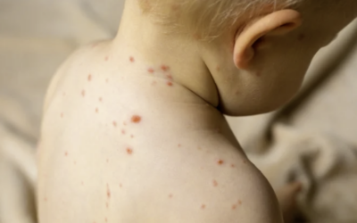 Masern eine ganz normale Kinderkrankheit